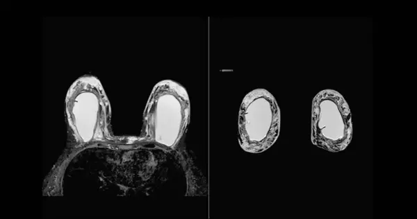 Mri Piersi Lub Rezonans Magnetyczny Piersi Obu Stronach Implantem Silikonu — Zdjęcie stockowe