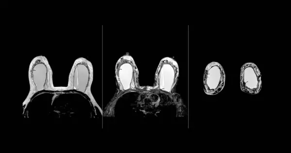 Mri Prsu Nebo Magnetická Rezonance Prsu Obou Stranách Silikonovým Implantátem — Stock fotografie
