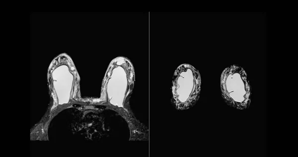 Brust Mrt Oder Magnetresonanztomographie Der Brust Beidseitig Mit Silikonimplantat Bei — Stockfoto