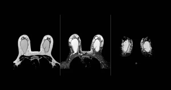Göğüs Göğüs Röntgeninin Her Iki Tarafında Göğüs Silikonu Olan Göğüs — Stok fotoğraf