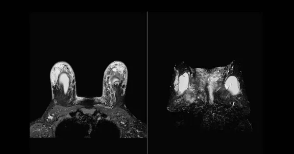 유방암 검진을 여성의 실리콘 임플란트와 유방암 양쪽의 Mri 자기공명영상 — 스톡 사진