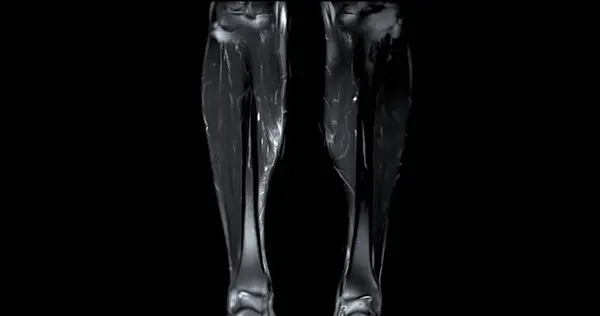 Ressonância Magnética Ambas Pernas Vista Coronal — Fotografia de Stock