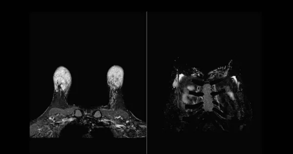 Mama Ressonância Magnética Mama Ambos Lados Com Implante Silicone Mama — Fotografia de Stock