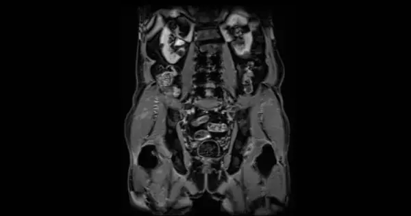 Irm Glándula Prostática Coronal T2W Para Diagnóstico Células Cancerosas Próstata —  Fotos de Stock