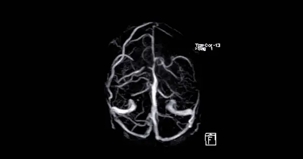Mrv Gehirn Oder Magnetresonanzvenographie Des Gehirns Zur Diagnose Von Anomalien — Stockfoto