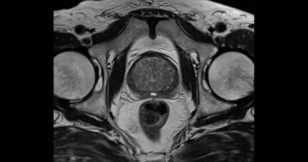 Glándula Prostática Axial T2W Para Diagnóstico Células Cancerosas Próstata Hombres —  Fotos de Stock