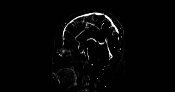 Mrv Brain Magnetic Resonance Venography Brain Diagnosis Abnormalities Venous Drainage — Stock Photo, Image