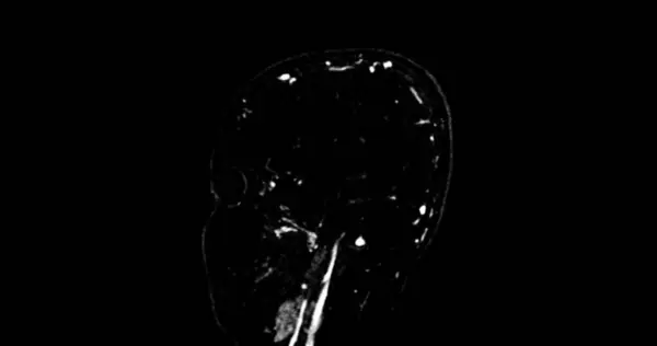 Mrv Brain Magnetic Resonance Venography Brain Diagnosis Abnormalities Venous Drainage — Stock Photo, Image