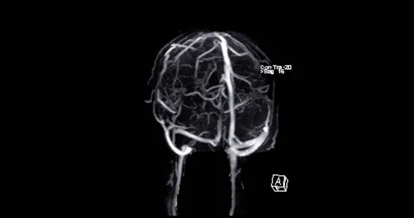 Mrv Мозок Або Магнітно Резонансна Вектографія Мозку Діагностики Аномалій Венозному — стокове фото