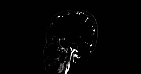 脳の毒性排水における診断異常のための脳のMrv脳または磁気共鳴位置 — ストック写真
