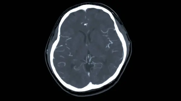 Tomografia Computadorizada Cérebro Com Meios Contraste Injeção Para Diagnóstico Tumor — Fotografia de Stock
