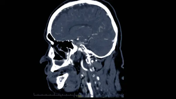 Головного Мозга Помощью Инъекционных Контрастных Сред Диагностики Опухоли Головного Мозга — стоковое фото