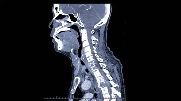 Spine Cervical Spine Sagittal View — Stock Photo, Image