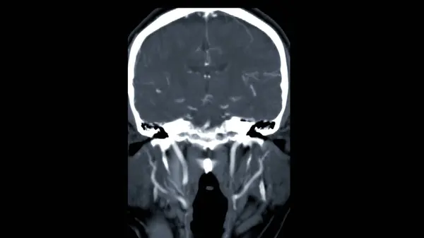 Sken Mozku Injekčními Kontrastními Médii Pro Diagnózu Mozkových Nádorů Cévní — Stock fotografie