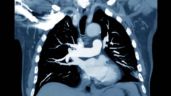 Ctpa Vagy Cta Pulmonalis Artéria Diagnosztikai Tüdőembólia Tüdőrák Kovid Kezelésére — Stock Fotó