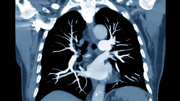 CTPA or CTA pulmonary artery for diagnostic Pulmonary embolism (PE) , lung cancer and covid-19. .