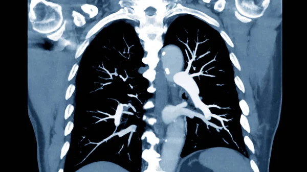 CTPA or CTA pulmonary artery for diagnostic Pulmonary embolism (PE) , lung cancer and covid-19. .