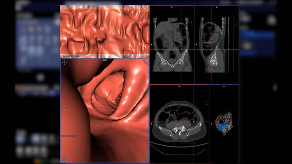 Ctコロナグラフィーは 大腸がんをスクリーニングするための2Daxial Sagittal および3Dレンダリングイメージを比較します 年間の健康診断で大腸がんをスクリーニングする — ストック写真