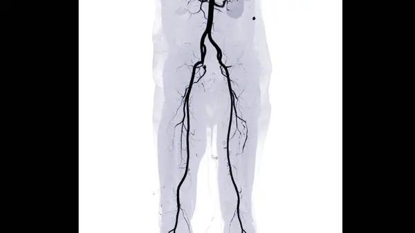Cta Arteria Femoral Que Muestra Arteria Femoral Para Diagnóstico Enfermedad — Foto de Stock