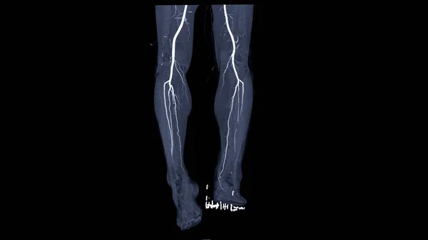 Cta Femoral Artery Run Showing Femoral Artery Diagnostic Acute Chronic — Stockfoto