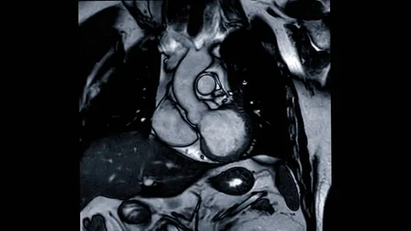Mri Coração Cardiaco Mri Ressonância Magnética Coração Vista Coronal Mostrando — Fotografia de Stock