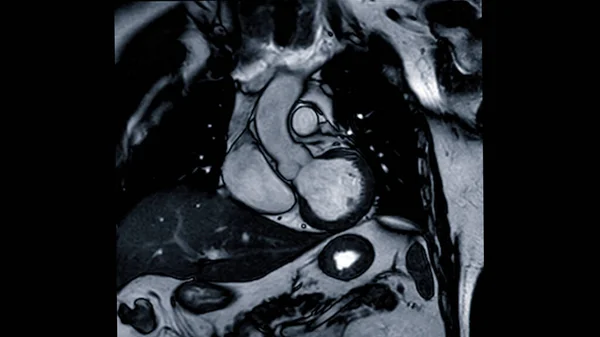 Mri心臓Mri 磁気共鳴画像法 心疾患を検出するための心臓の鼓動を示すコロナビュー — ストック写真