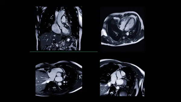 Mri心臓または心臓Mri 心臓病を検出するための磁気共鳴イメージング — ストック写真