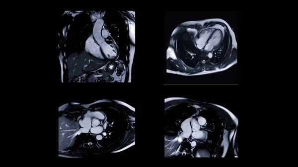 心脏Mri或心肌Mri 磁共振成像 检测心脏病 — 图库照片