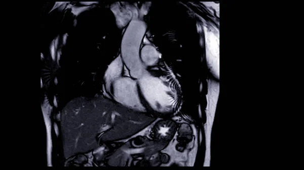Mri Coração Cardiaco Mri Ressonância Magnética Coração Vista Coronal Mostrando — Fotografia de Stock
