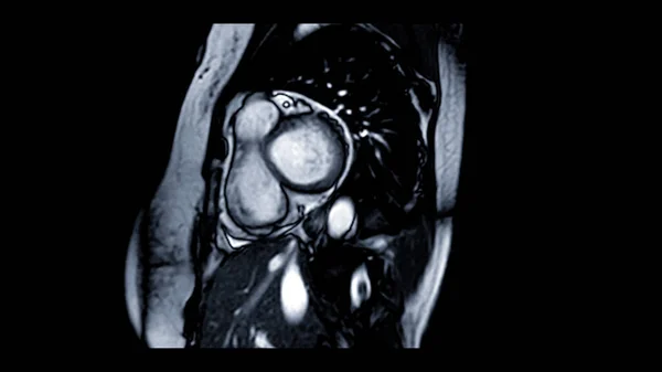 MRI heart or Cardiac MRI ( magnetic resonance imaging ) of heart in Short axis  view showing heart beating of  2 chamber for detecting heart disease.
