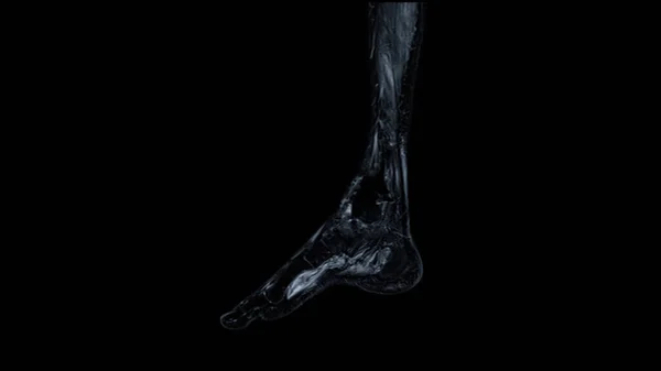 Mrt Foot Scan Sagittal View Fettunterdrückungstechnik Zur Diagnostischen Sehnenverletzung — Stockfoto