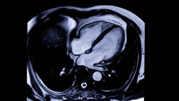Mri Coração Ressonância Magnética Cardíaca Ressonância Magnética Coração Para Detectar — Fotografia de Stock