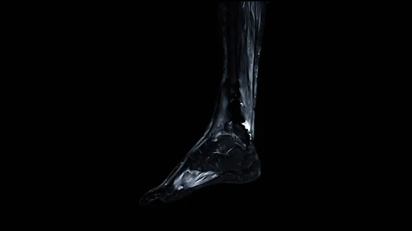 Mri Foot Taraması Sagittal Görünüm Yağ Bastırma Tekniği Teşhis Tendonu — Stok fotoğraf