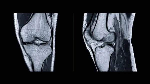 Magnetische Resonantie Beeldvorming Van Kniegewricht Mri Knie Sagittal Voor Het — Stockfoto