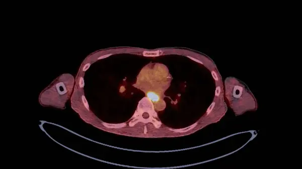 PET CT image of Whole human body  Axial ,coronal and sagittal plane. Positron Emission Computed Tomography .
