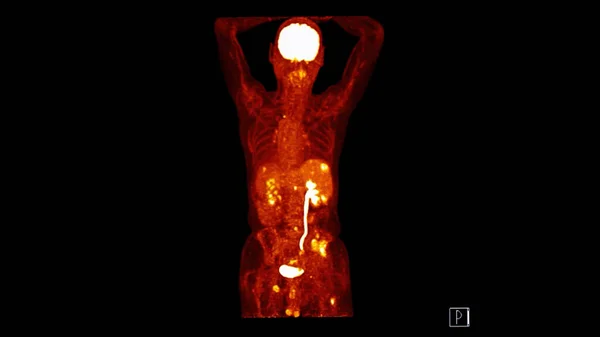 全人体コロナ平面のPetct画像 ポシトロン エミッション コンピューティング トモグラフィー — ストック写真