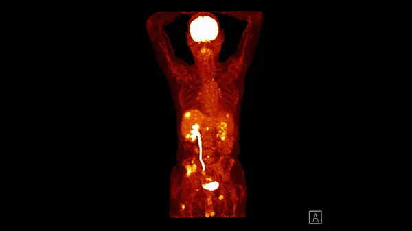 PET CT image of Whole human body  coronal plane. Positron Emission Computed Tomography .