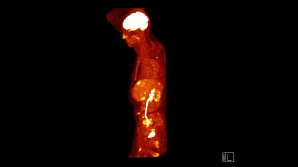 全人体シッタール平面のPetct画像 ポシトロン エミッション コンピューティング トモグラフィー — ストック写真