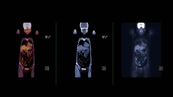 全人体軸 角および賢明な平面のPetctイメージ ポシトロン エミッション コンピューティング トモグラフィー — ストック写真
