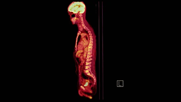 PET CT image of Whole human body   sagittal plane. Positron Emission Computed Tomography .