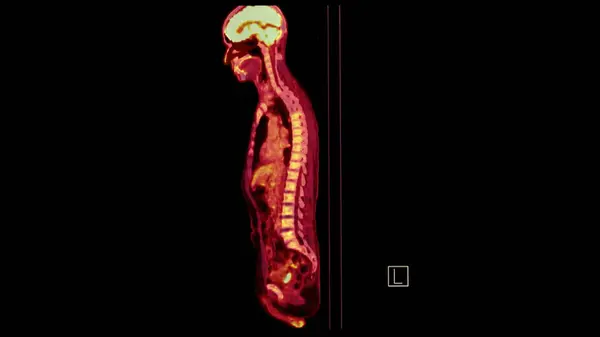 Pet Bild Des Gesamten Menschlichen Körpers Sagittale Ebene Positronenemissionscomputertomographie — Stockfoto