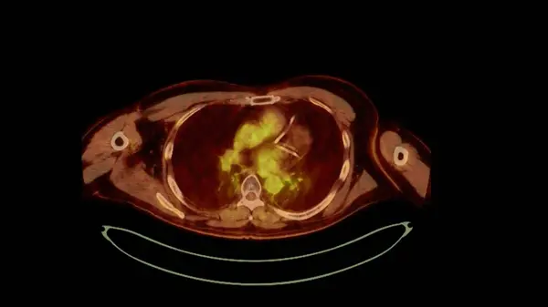 PET CT image of Whole human body  Axial  plane. Positron Emission Computed Tomography .