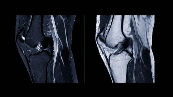 Magnetic Resonance Imaging Knee Joint Mri Knee Sagittal Detect Tear — Stock Photo, Image