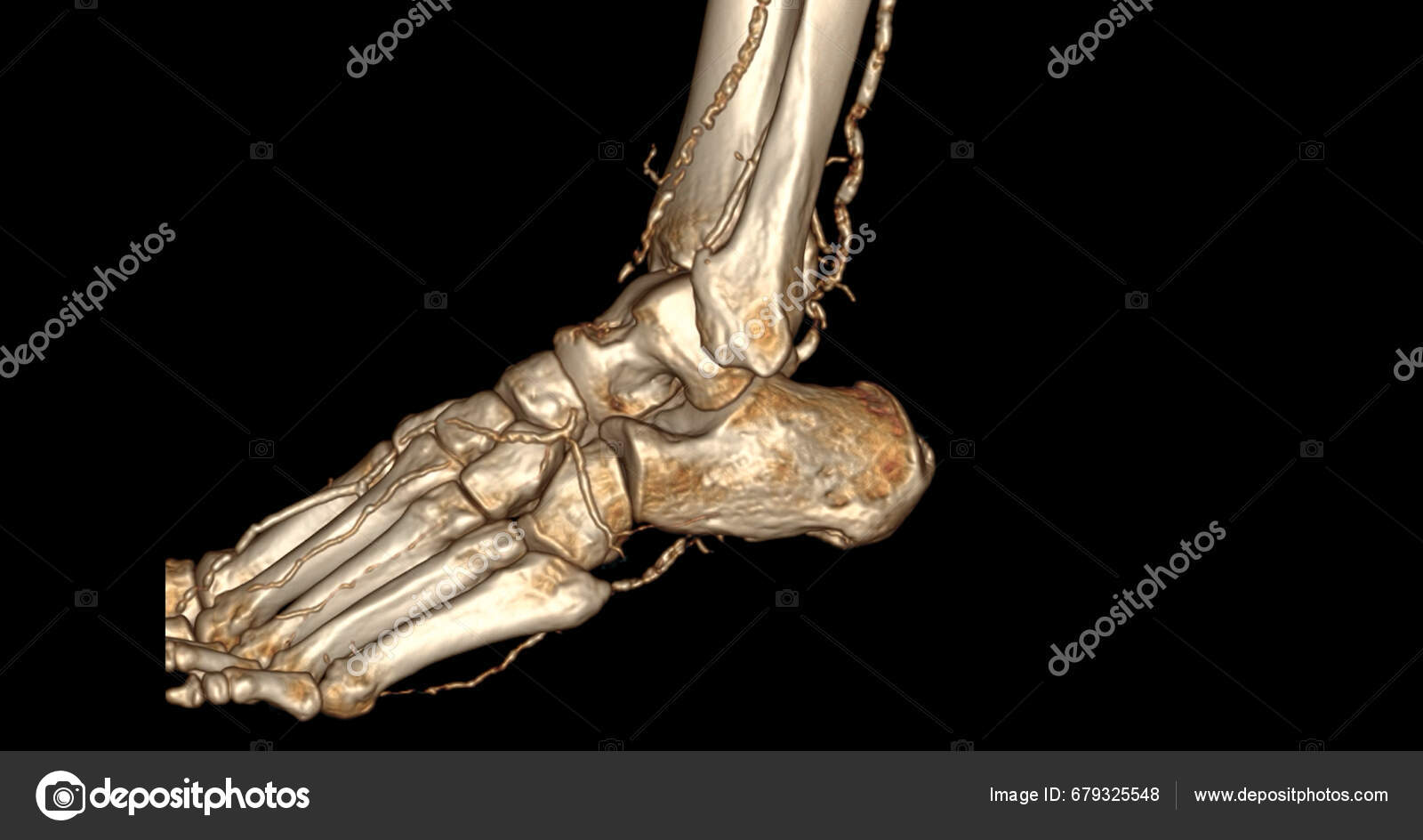 Escaneo Del Pie Para Diagnóstico Enfermedades Del Pie Por Scanner