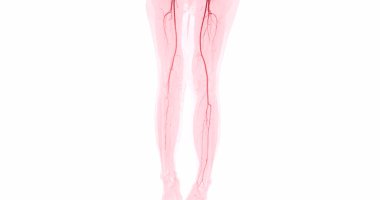 Kronik Akut veya Kronik Periferik Arter Hastalığı teşhisi için femoral arterin görüntüsü alınamıyor..