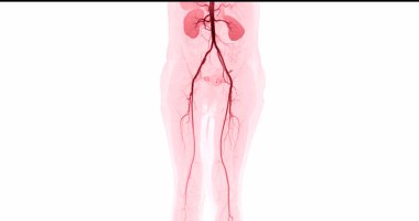 Kronik Akut veya Kronik Periferik Arter Hastalığı teşhisi için femoral arterin görüntüsü alınamıyor..