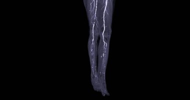 CTA femoral artery run off image of femoral artery for diagnostic Acute or Chronic Peripheral Arterial Disease. clipart