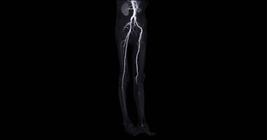 Kronik Akut veya Kronik Periferik Arter Hastalığı teşhisi için femoral arterin görüntüsü alınamıyor..