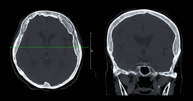 Beyin tümörü, felç ve damar hastalıkları için beyin sagital görüşünün CT taraması.