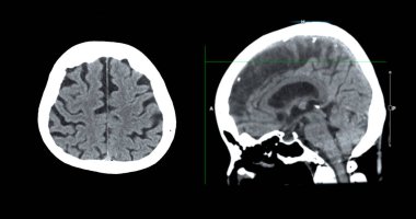 Beyin tümörü, felç ve damar hastalıkları için beyin sagital görüşünün CT taraması.